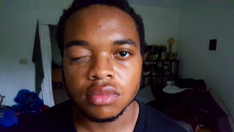 The beginning of my eye infections. Yes it got worse.